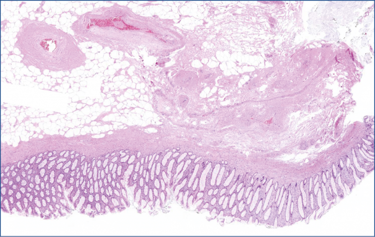 Lipoma of the coecum with secondary changes of the surface – Central ...